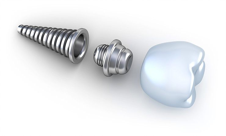 Los Implantes Dentales y sus Ventajas